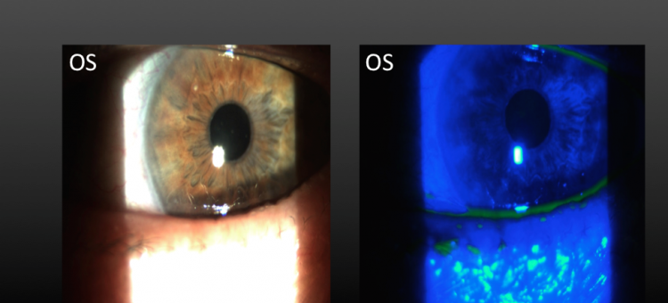 Циклоспорин А 0,05% Сухой глаз после хирургии