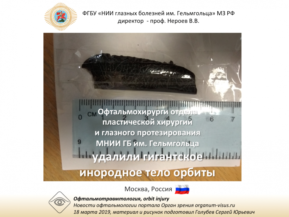 Гигантское инородное тело орбиты Успешная операция