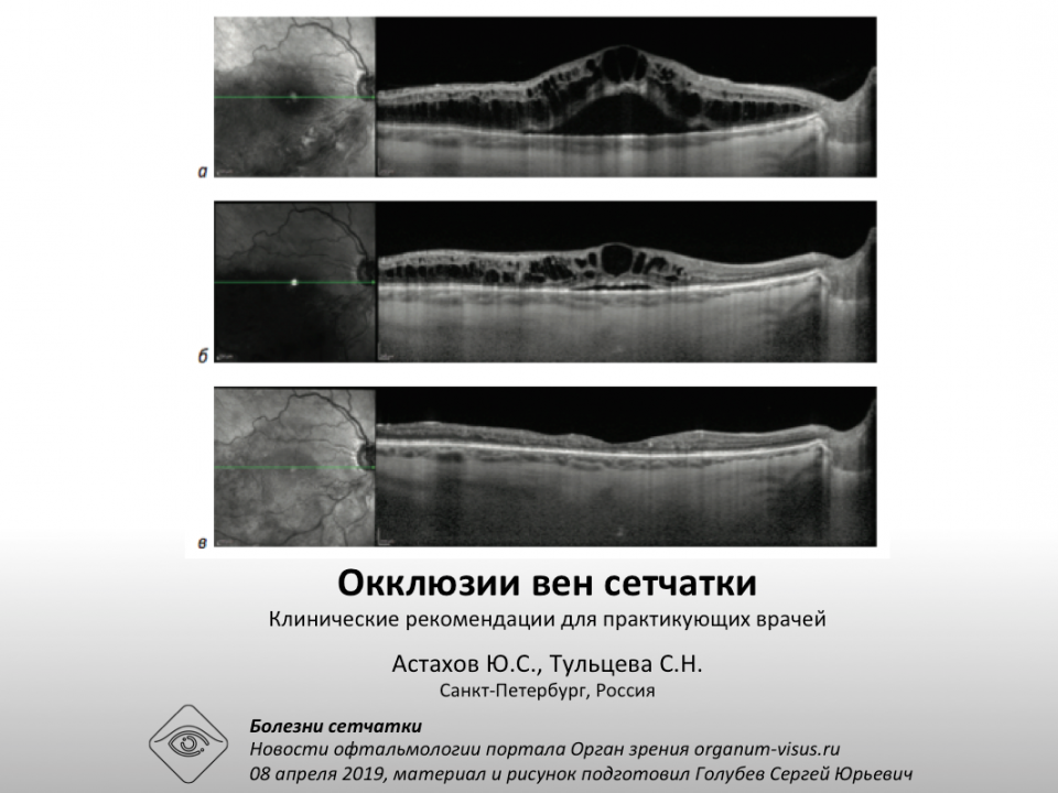 Окклюзии вен сетчатки Анонс