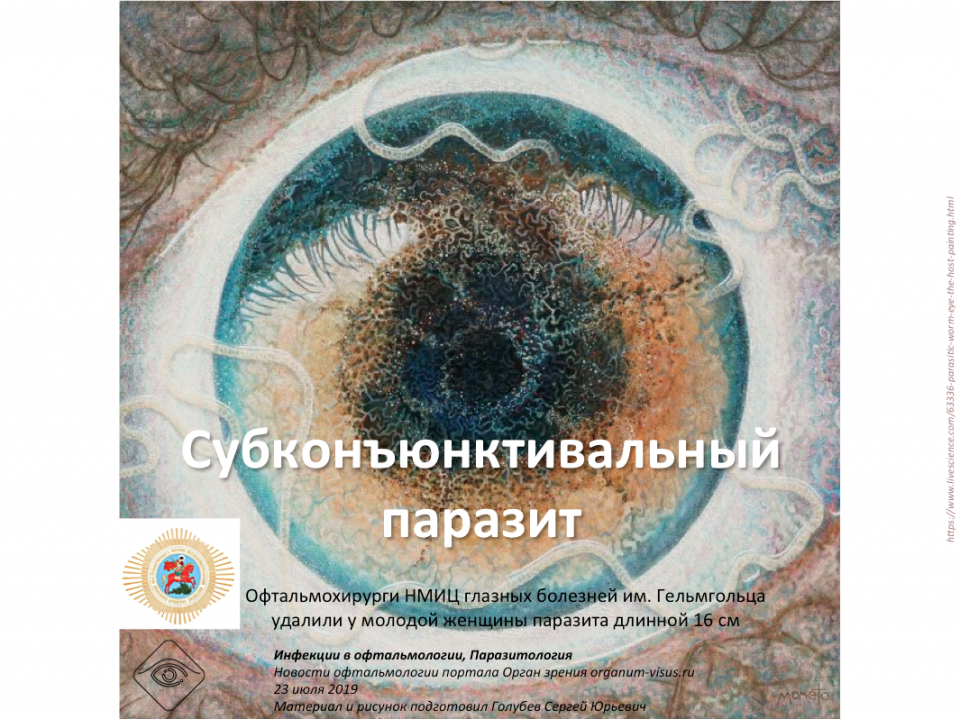 Субконъюнктивальный паразит удален в НМИЦ ГБ им Гельмгольца