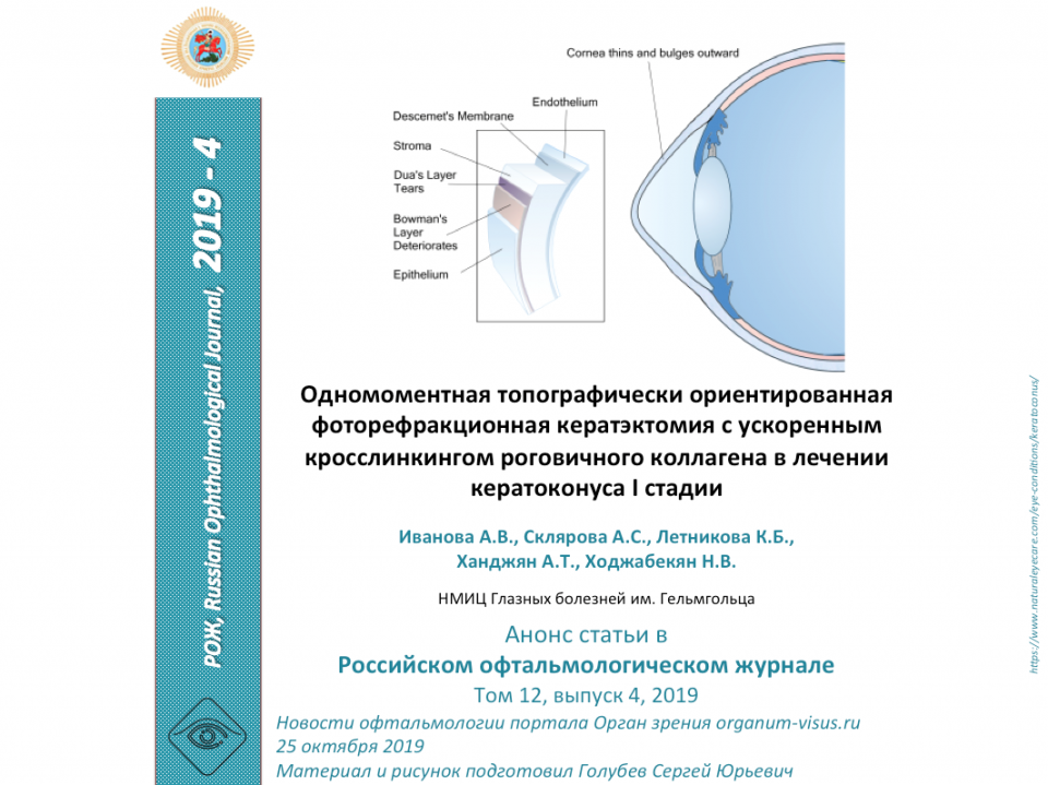 Кросслинкинг в лечении кератоконуса I стадии