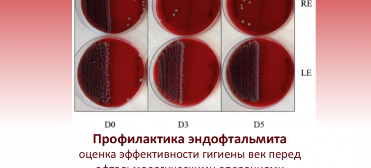 Профилактика эндофтальмита Блефаклин и глазная поверхность