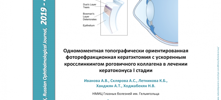 Кросслинкинг в лечении кератоконуса I стадии