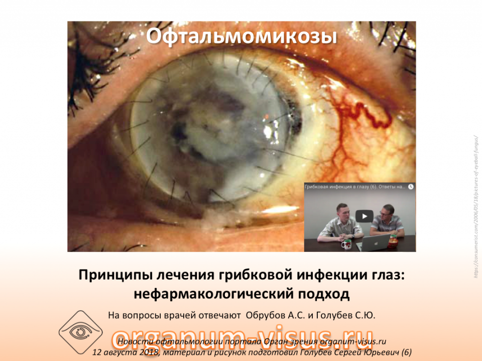 Ответы на вопросы специалистов Офтальмомикозы