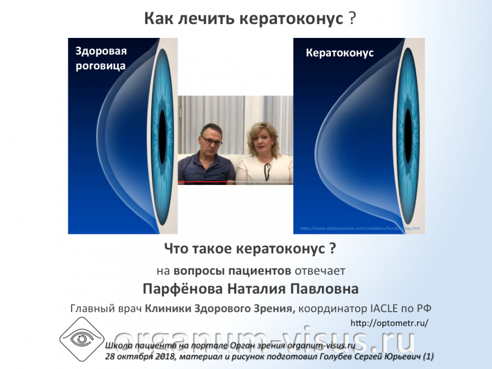 Вопрос пациента Что такое кератоконус