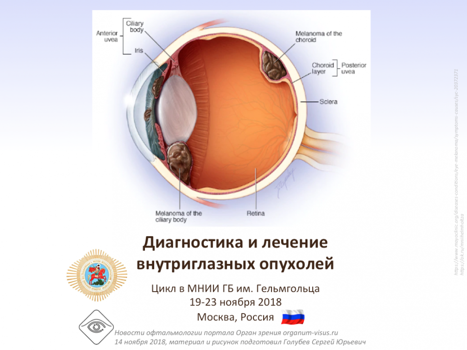 Учеба по офтальмологии Офтальмоонкология в МНИИ ГБ Гельмгольца