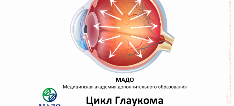 Учеба по офтальмологии Глаукома МАДО
