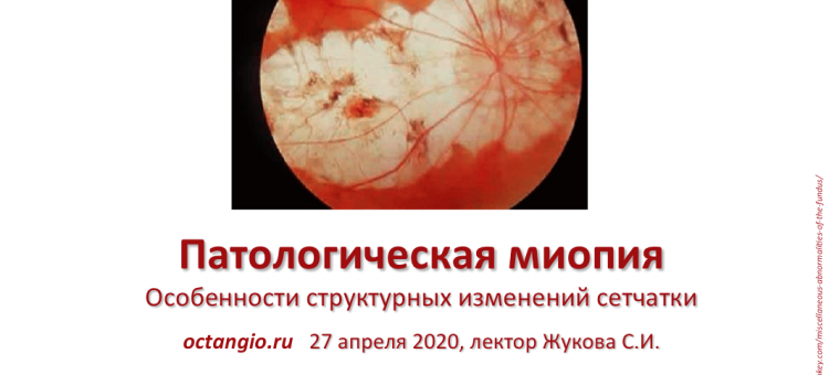 ОКТА 2020 ОКТ ангиография Лекция 2