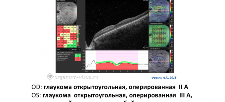 Клинический пример Глаукома Травма глаза